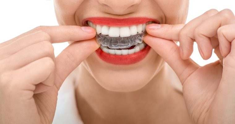 Check Top 6 Benefits When You Are Thinking About Invisible Braces