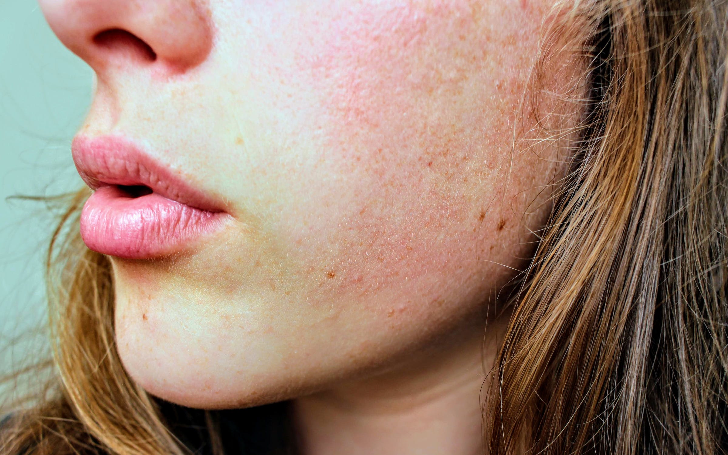 All you need to know about Eczema