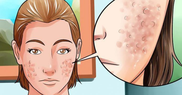 Getting Rid of Acne Scars and Marks