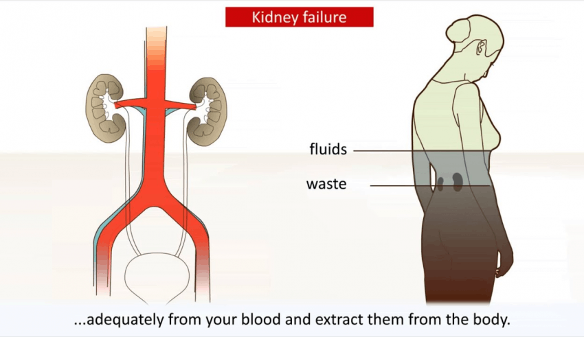 7 Common Signs of Kidney Disease