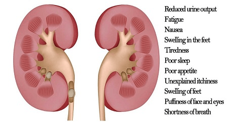 failed kidney