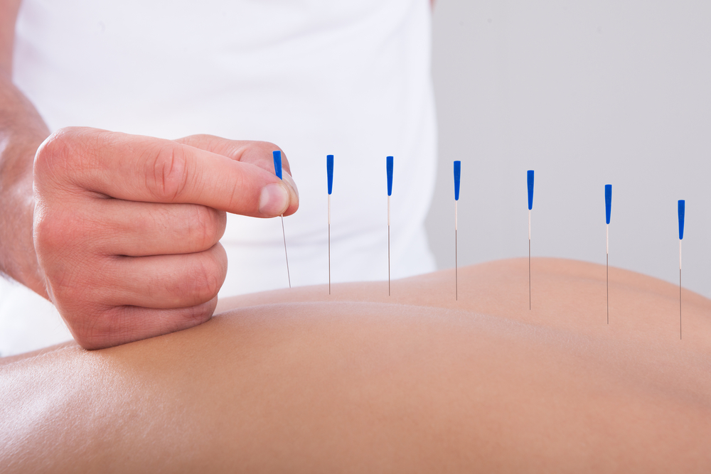 What You Need to Know About Acupuncture in Houston