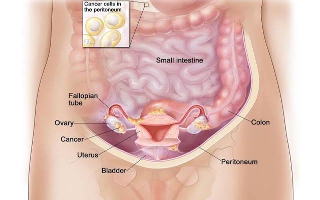 Ovarian Cancer: Definition, Symptoms & Causes
