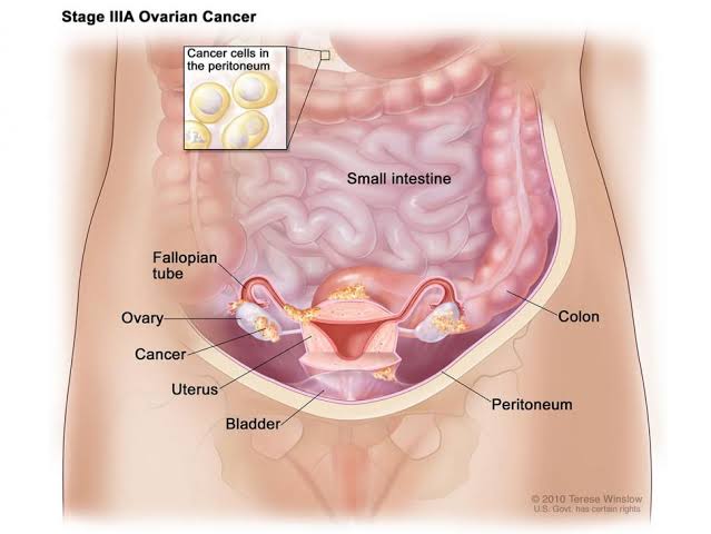 Ovarian Cancer: Definition, Symptoms & Causes