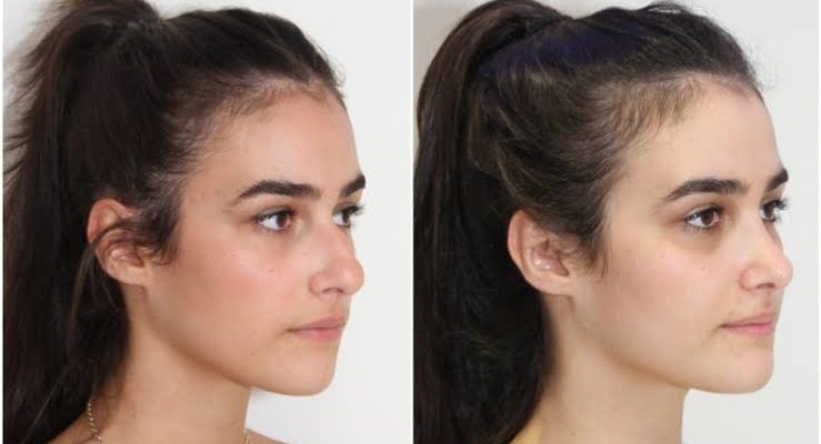 Rhinoplasty Aftercare Tips: What to Do After Your Nose Job