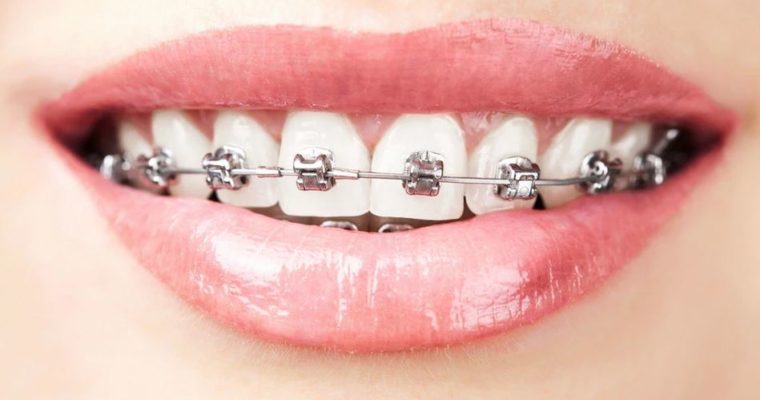 Wear a Smile Daily with Clear Braces