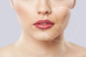 Acne Scar Removal in Singapore – What They Are And How To Get Rid of Them