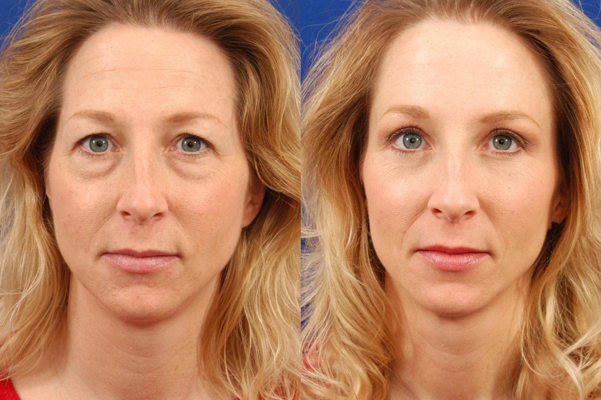 What Is Blepharoplasty and Should You Get One?