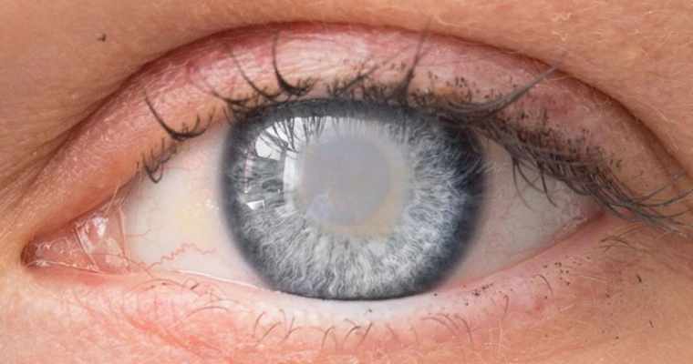 What Are Cataracts and Their Symptoms?