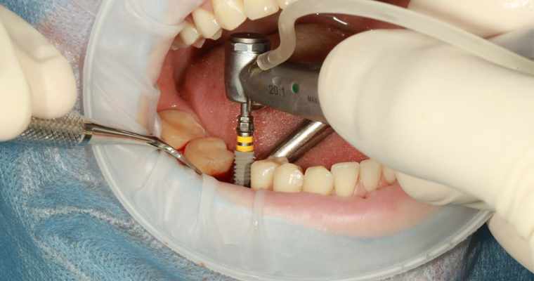 6 Surprising Facts About Dental Implants You Didn’t Know