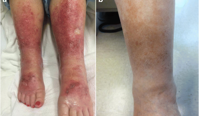 Tips to Help Prevent Your Venous Stasis Dermatitis from Worsening