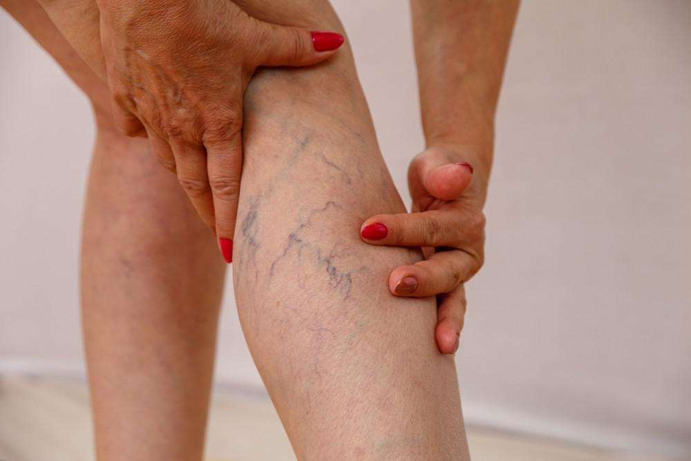 Tips To Improve the Appearance of Spider Veins