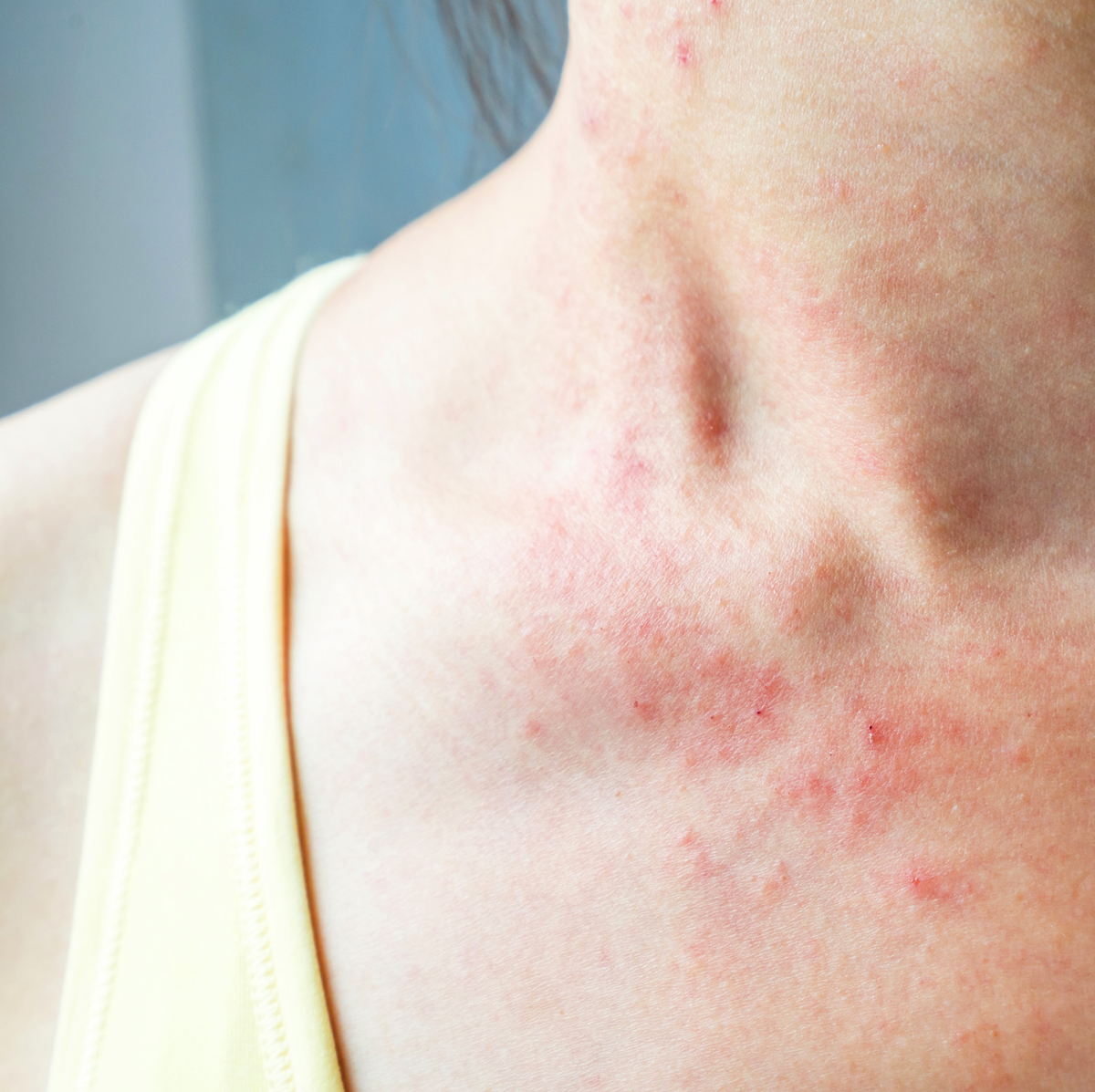 6 Reasons to Seek Medical Attention for Your Skin Rash