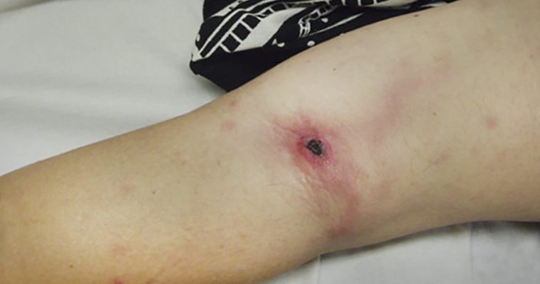 4 Likely Complications From Poor Wound Care