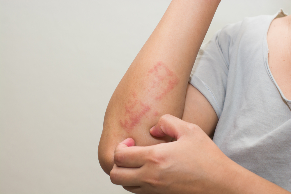 Top 6 Effective Tips for Dealing with Eczema