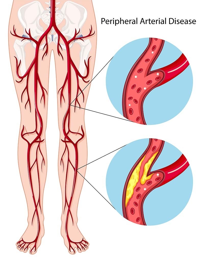 Treatment Options for Peripheral Arterial Disease