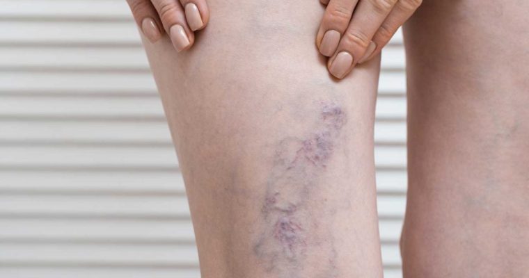 Everything you need to know about Varicose Veins