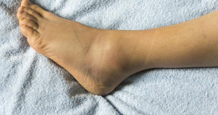 How to Deal With Leg Swelling