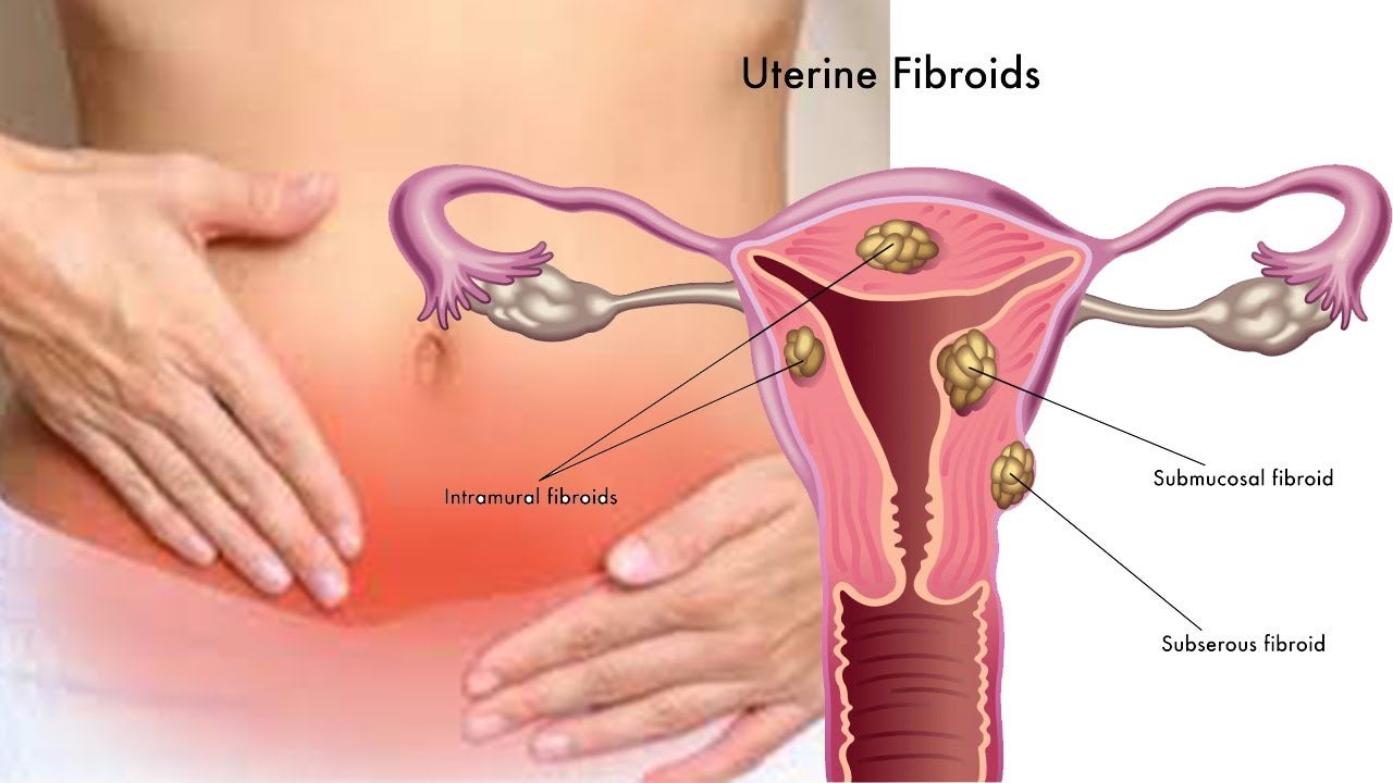 Treatments Options for Uterine Fibroids