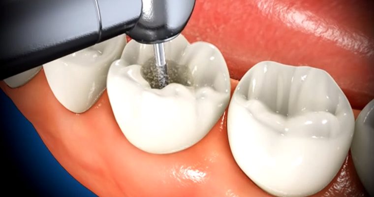 5 Common Myths Revolving Around the Root Canal Treatment