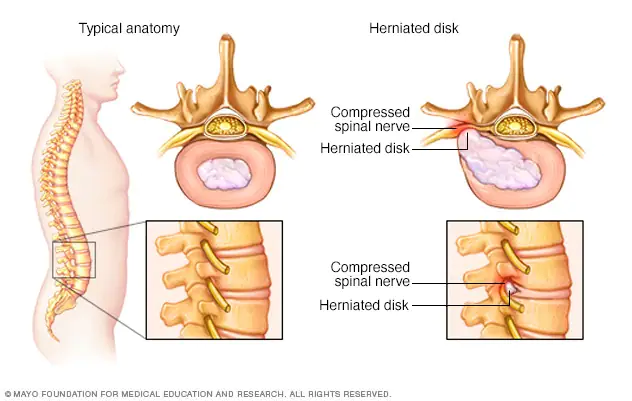 Herniated Disc: What Is It and What Is the Causes?
