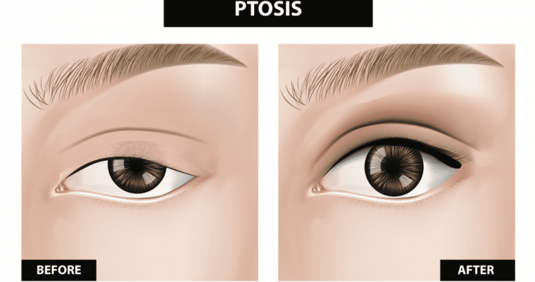 7 Warning Signs of Ptosis To Watch Out For
