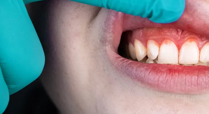 Common Causes of Gum Swelling