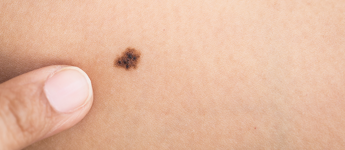 When Should You Worry About a Mole?