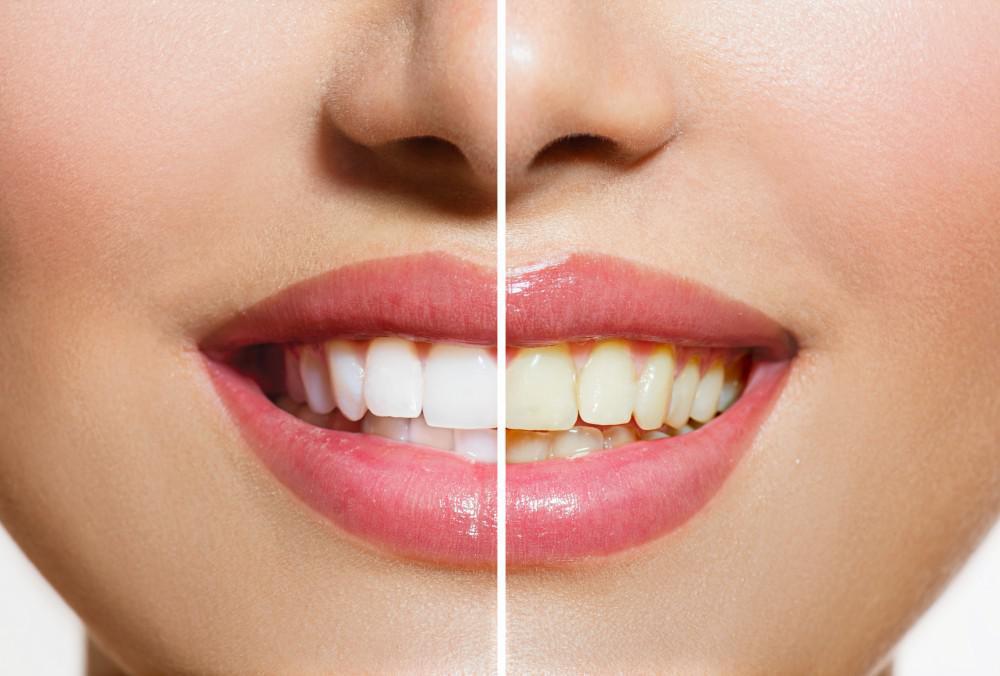 Reasons to Consider Professional Teeth Whitening