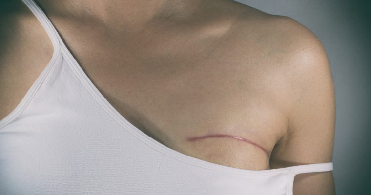 What You Need To Know About Breast Reconstruction Surgery