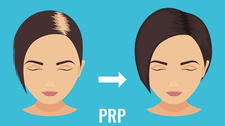 Tops Reasons to Consider PRP Hair Restoration