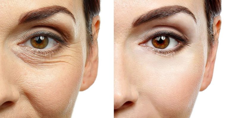 Understanding the Different Types of Wrinkles and How to Treat Them