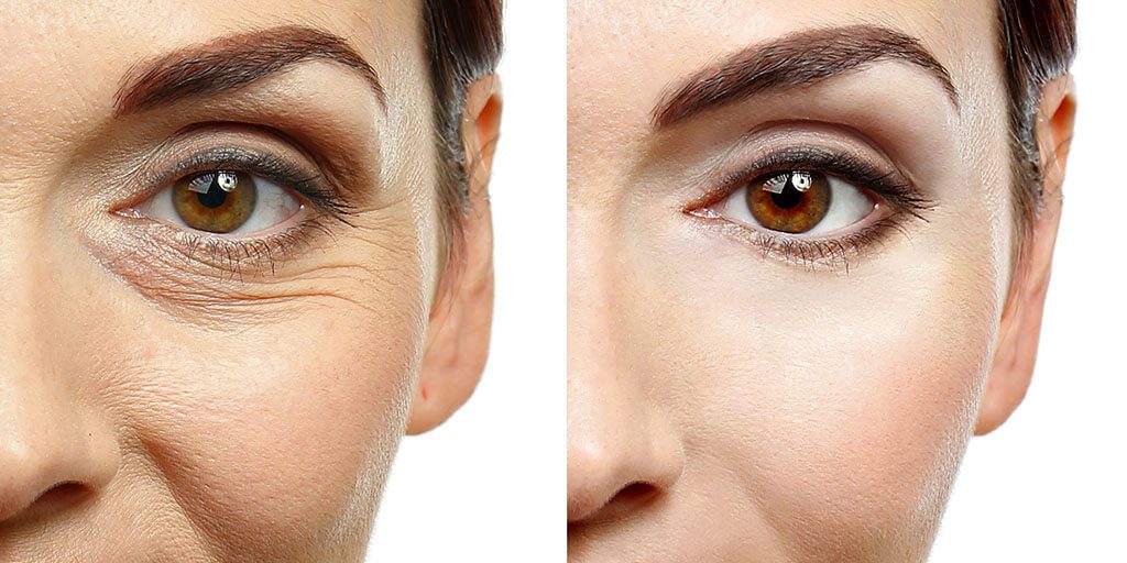 Understanding the Different Types of Wrinkles and How to Treat Them